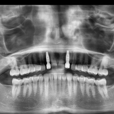 Panoramic X-ray after two implants were placed for congenitally missing upper teeth