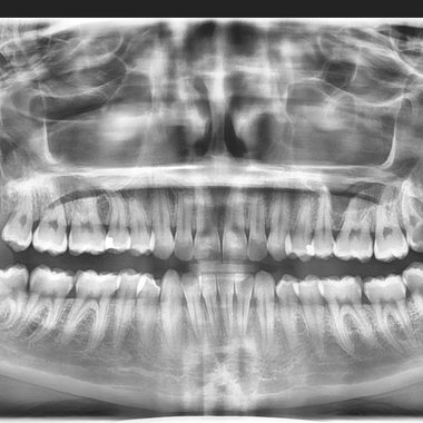Panoramic X-ray showing partially erupted lower wisdom teeth before removal