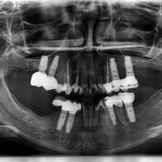 Panoramic radiograph showing a completed full-arch dental implant case