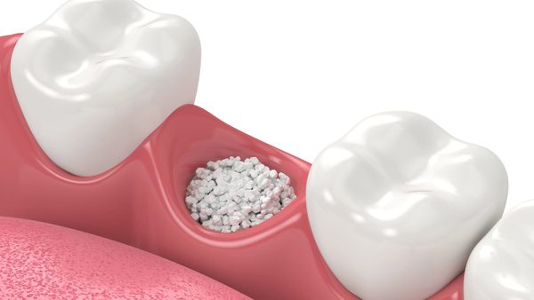 Illustration of bone graft material placed in a tooth socket