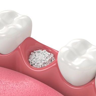 Illustration of bone graft material placed in a tooth socket