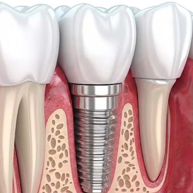 Cross-section illustration of a dental implant placed in the jawbone