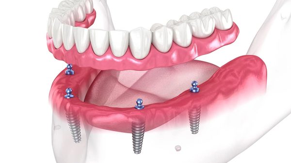 Full-arch implant-supported prosthesis on four dental implants