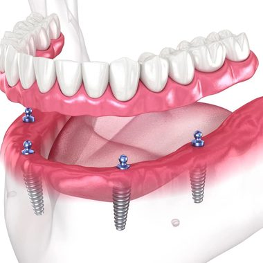 Full-arch implant-supported prosthesis on four dental implants