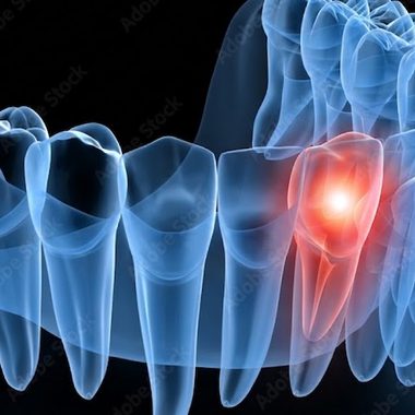3D illustration of an impacted canine tooth in the dental arch