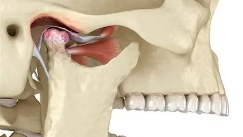Anatomical illustration of the temporomandibular joint