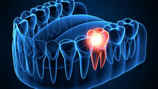 3D illustration highlighting a tooth scheduled for extraction