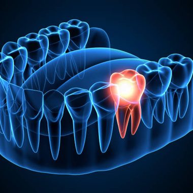 3D illustration highlighting a tooth scheduled for extraction