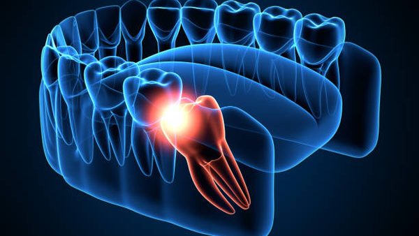 3D illustration of an impacted wisdom tooth in the lower jaw