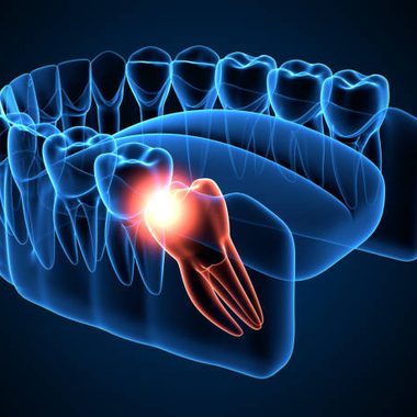 3D illustration of an impacted wisdom tooth in the lower jaw